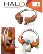 HALO UNIVERSAL MOLAR RING Anello 1PZ Ultradent